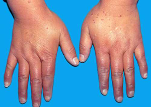 TCM Treatment for rheumatic arthritis