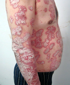 TCM Treatment for psoriasis