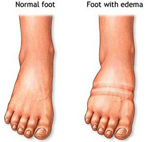TCM Treatment for edema