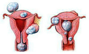 TCM Treatment for fibroid