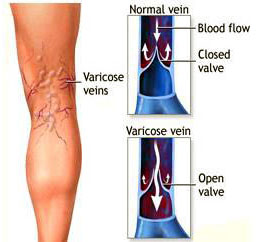 TCM Treatment for varicose veins