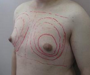TCM Treatment for abnormal development of male breast