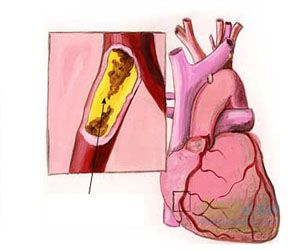 TCM Treatment for coronary artery spasm