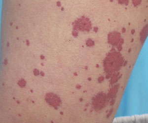 TCM Treatment for allergic purpura