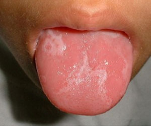 TCM Treatment for oral lichen planus (olp)