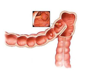TCM Treatment for intestinal obstruction