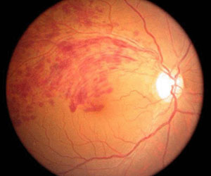 TCM Treatment for retinal vein obstruction