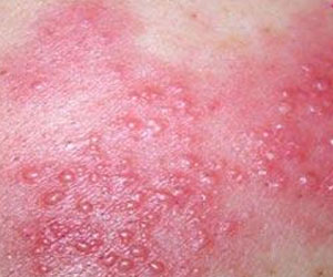 TCM Treatment for herpes zoster