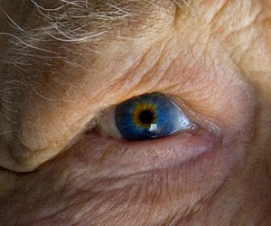 TCM Treatment for senile macular degeneration