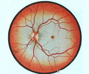 TCM Treatment for obstruction of retinal artery