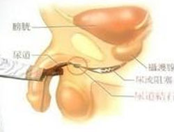 TCM Treatment for urethral spasm