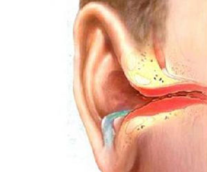 TCM Treatment for inflammation of external auditory canal