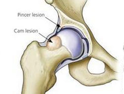 TCM Treatment for hip pain