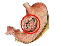 TCM Treatment for gastric cancer (carcinoma)