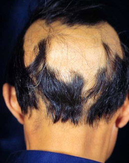 TCM Treatment for alopecia areata