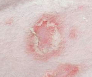 TCM Treatment for superficial dermatomycosis