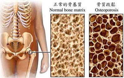 TCM Treatment for osteoporosis