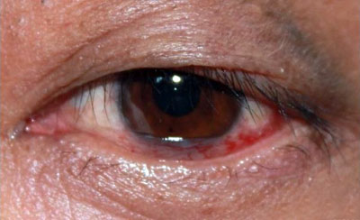 TCM Treatment for bacterial corneal ulcer