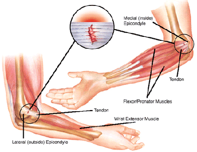 TCM Treatment for tennis elbow