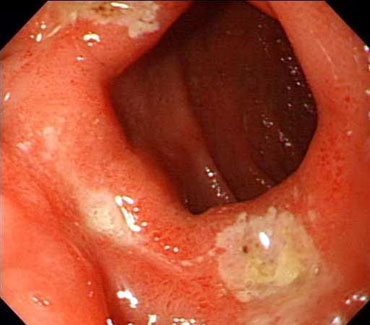 TCM Treatment for duodenal ulcer