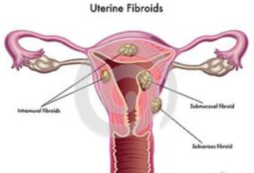 TCM Treatment for uterine fibroids