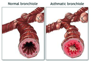TCM Treatment for bronchial asthma
