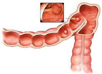TCM Treatment for stomach cancer