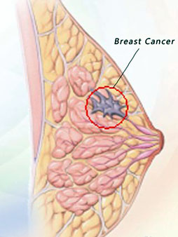 TCM Treatment for breast cancer