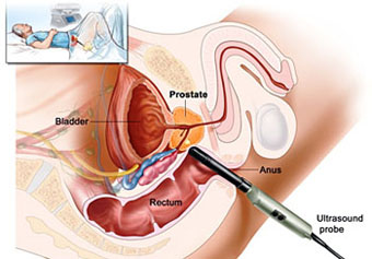 TCM Treatment for prostate cancer