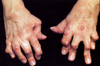 TCM Treatment for rheumatoid arthritis