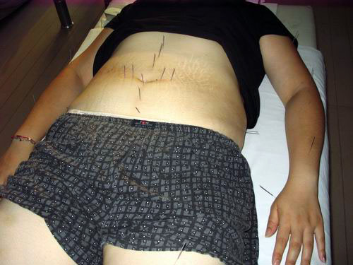 body acupuncture therapy