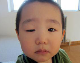 definition of eyelid ptosis in tcm