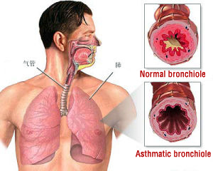 definition of asthma in tcm