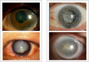 definition of cataract in tcm
