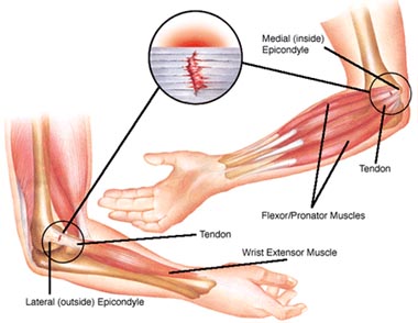 definition of tennis elbow in tcm