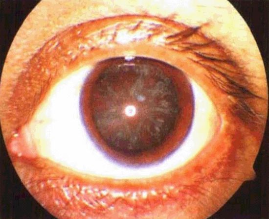 glaucoma successfully treated with chinese medicine