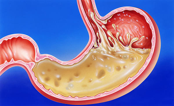 how to treat acid stomach effectively by natural remedy