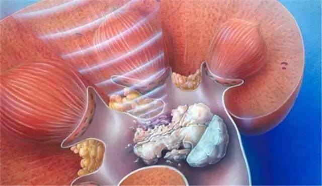 natural remedy for kidney infection, kidney infection home cure