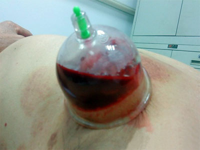 Suction Cup Therapy, traditional Chinese medicine