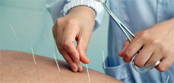 Acupuncture Single points