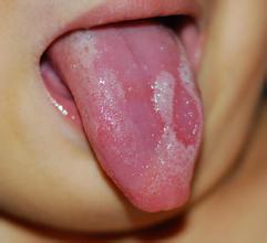 geographic tongue natural remedy, geographic tongue home treatment