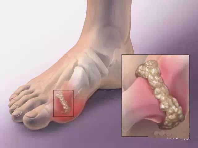 herbal remedies for gout, gout natural home cure