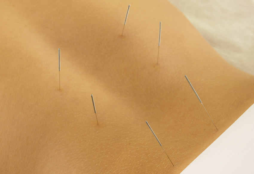 acupuncture, a standalone therapy for irritable bowel syndrome
