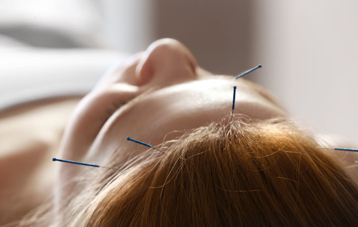 acupuncture enhances outcome rates for patients with headaches