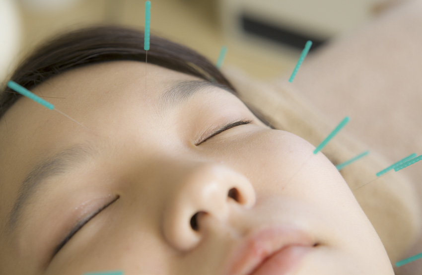 acupuncture reverses facial paralysis due to bell palsy
