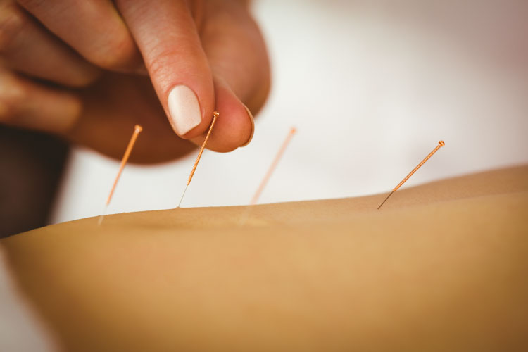 acupuncture is significantly effective for diarrhea due to ibs
