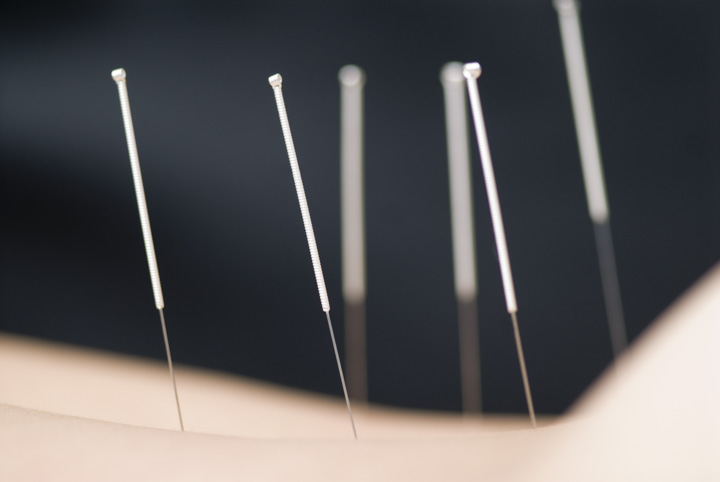 acupuncture helps increase bone strength and bone loss