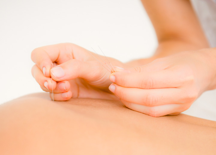 acupuncture relieves pain due to shingles