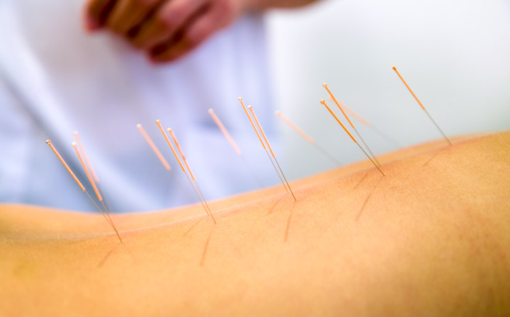 acupuncture for elderly patients suffering from chronic bronchitis