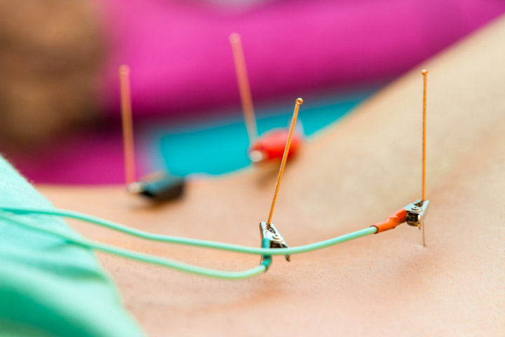 acupuncture provides relief for postcholecystectomy syndrome